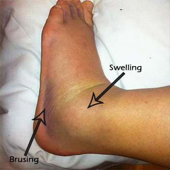 Ankle fracture