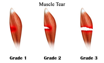 muscle tear