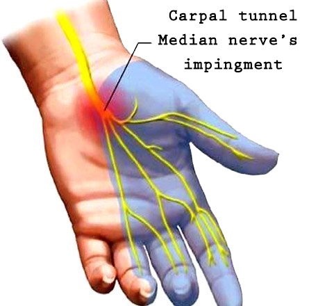 How to properly perform a Carpal Tunnel forearm massage