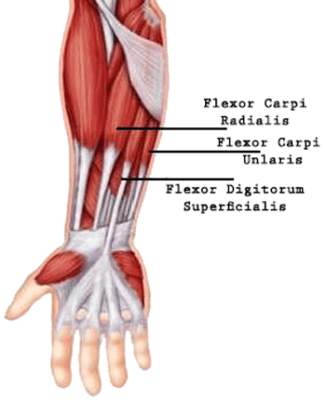 Golfer's Elbow