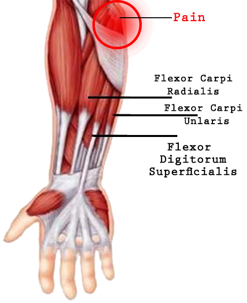 Golfer's Elbow How massage can help in managing this condition?