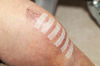 Wound of a knee post surgery