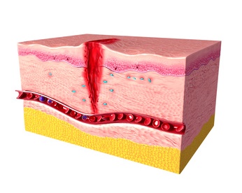Representation of a wound post surgery