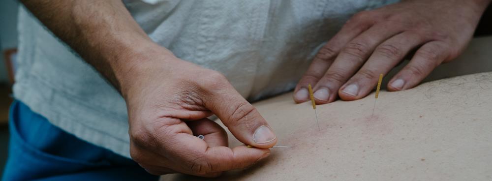 Dry Needling on Shoulder