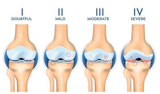 Osteoarthritis diagram