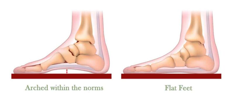 a picture with normal feet and a flat feet