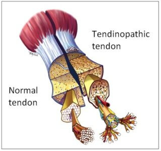 rapresentation of a Tendinopathy 