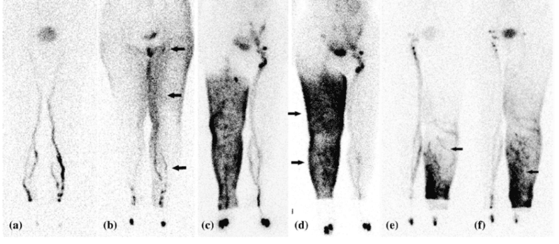 Imaging for lymphoedema diagnosis
