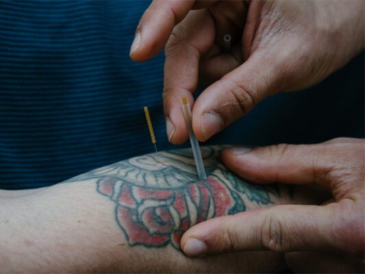 2 hands placing a dry needle into an arm