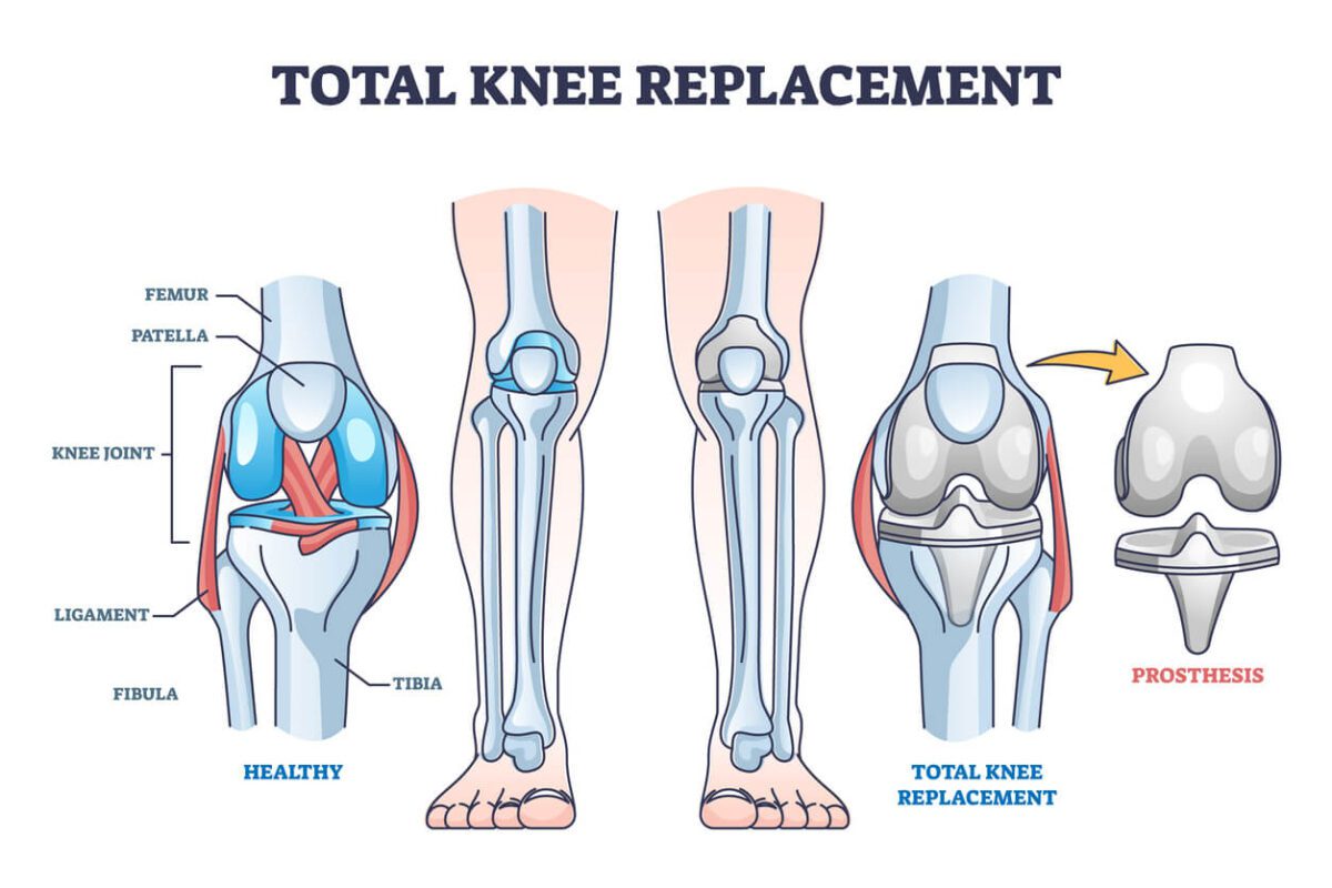 Diagram of Knee Replacement