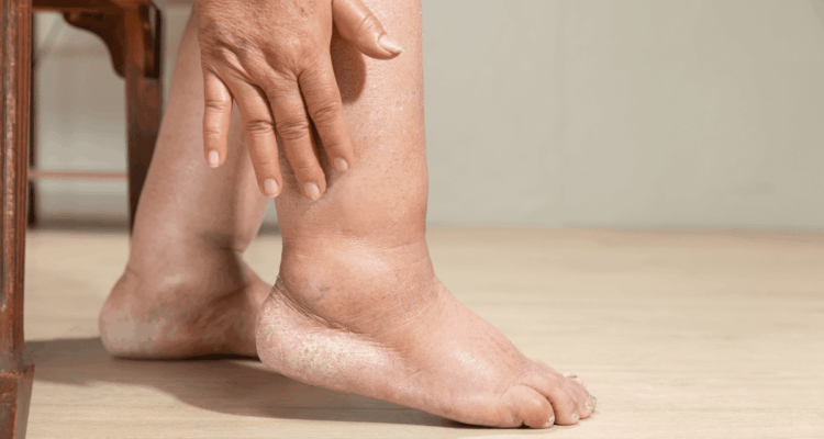 An image showing Leg swelling