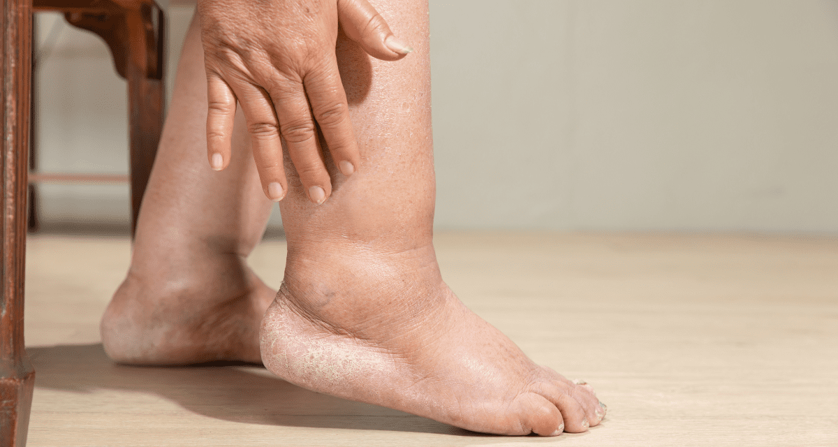 An image showing Leg swelling