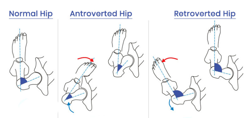 A drawing of Normal hip in comparison to Femoral Anterversion Retroversion