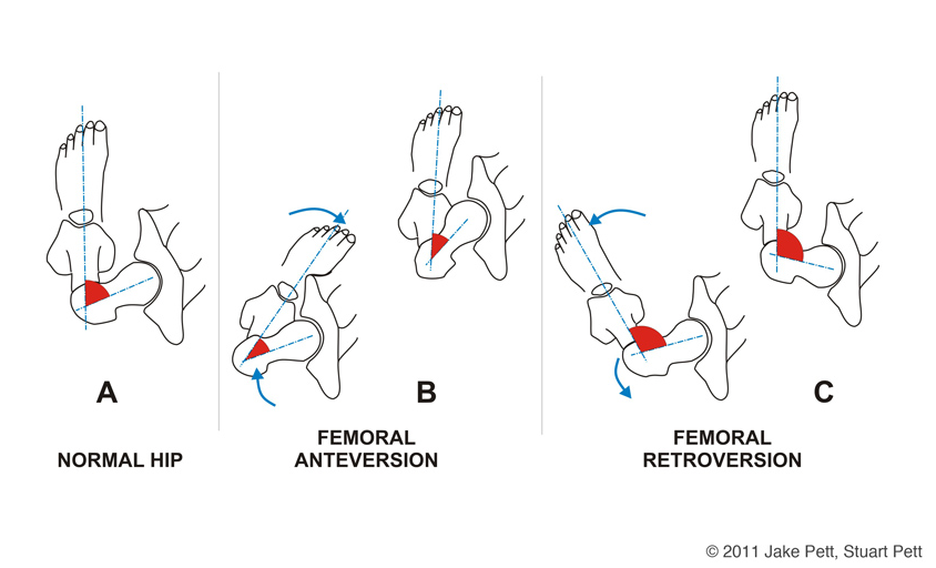 A picture that shows a visual of Femoral Anteversion diagram