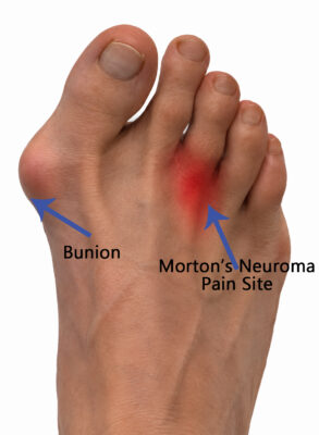 Morton's Neuroma pain site, which can be affected by Bunion
