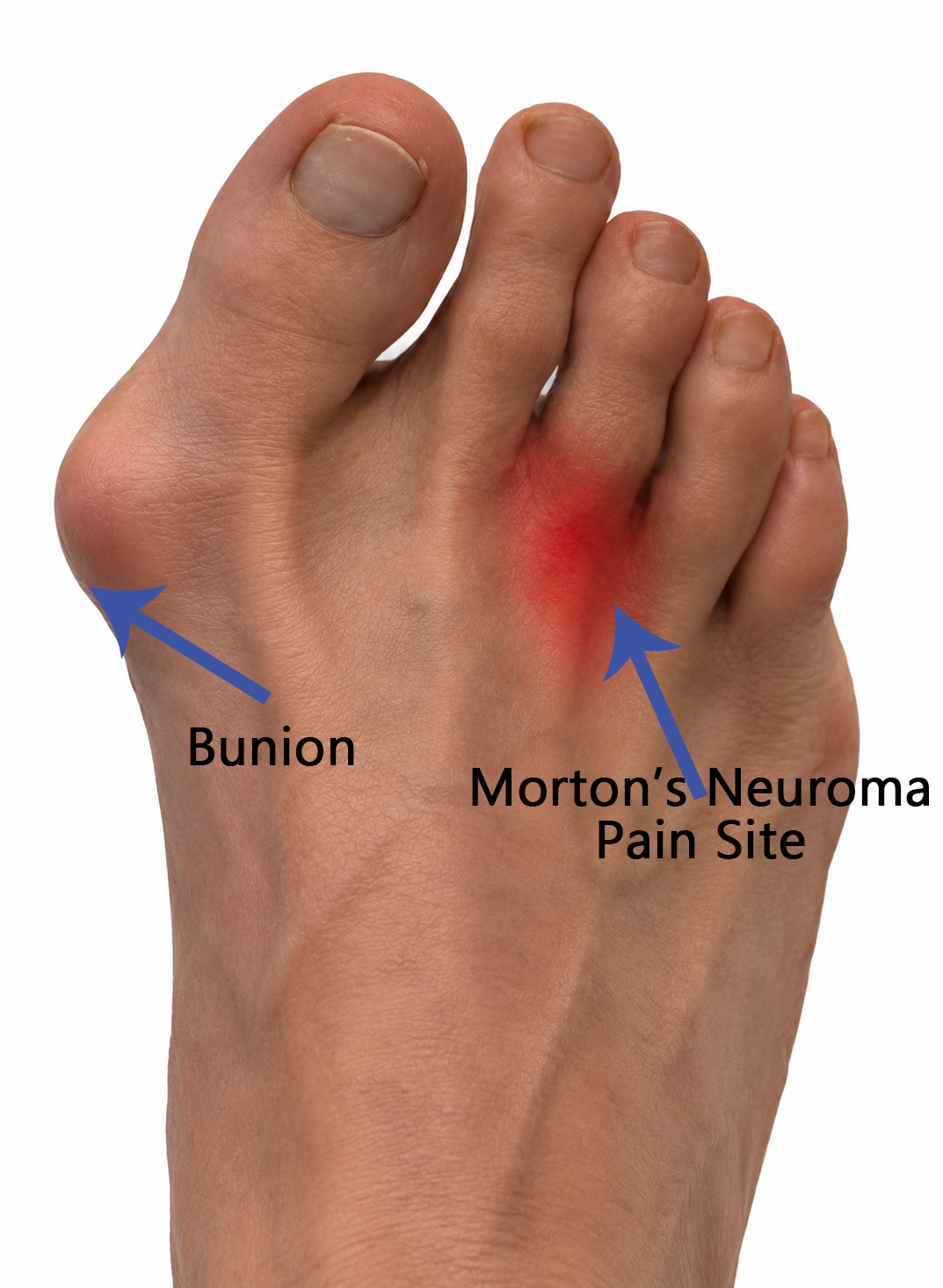 Morton's Neuroma pain site, which can be affected by Bunion